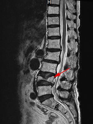 Case report: Denosumab-associated acute heart failure in patients with cardiorenal insufficiency